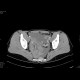 Corpus luteum cyst: CT - Computed tomography